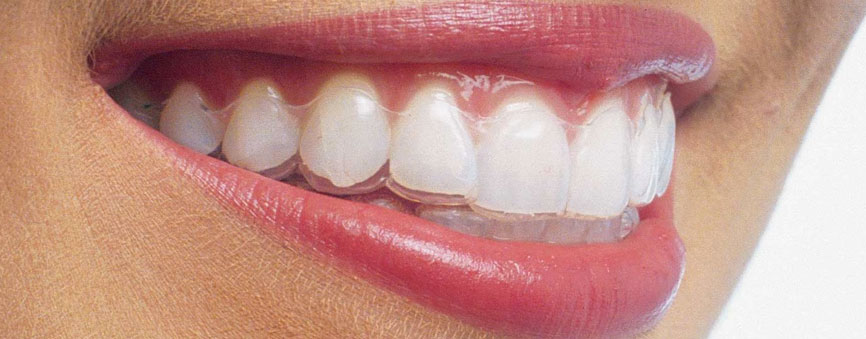 Sorriso con allineatore trasparente
