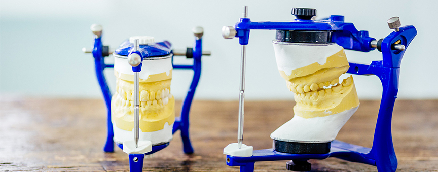 Modelli in gesso montati in articolatore